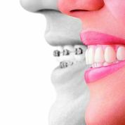 metal braces vs Invisalign aligners