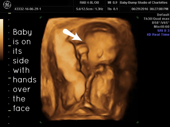 gender reveal ultrasound 1