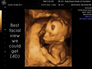 gender reveal sonogram